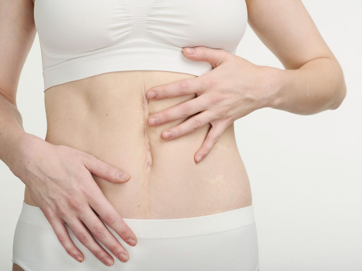 Person berührt eine vertikale Bauchnarbe nach Laparotomie – typisches Beschwerdebild in der Narbentherapie