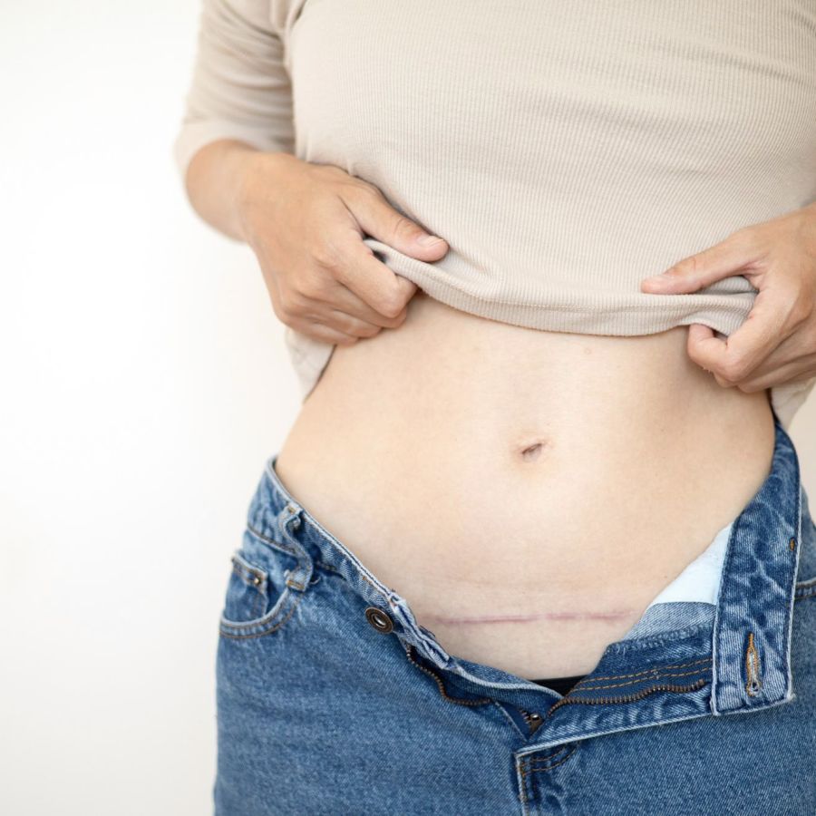 Terapia cicatrici e aderenze / Serena Noto - Osteopatia Berlin